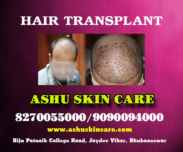 best hair transplant clinic in bhubaneswar close to sum hospital
